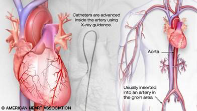 Catheters are advanced inside the artery using X-ray guidance, usually inserted into an artery in the groin area.